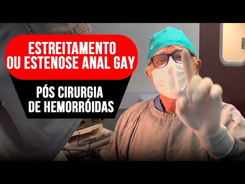 Como evitar estreitamento,estenose anal gay após cirurgia Hemorroidas,proctologista ensina: