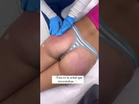 💉🍑Aquí tienes la señal definitiva para que te regales un exclusivo diseño de glúteos esta Navidad 🎄
